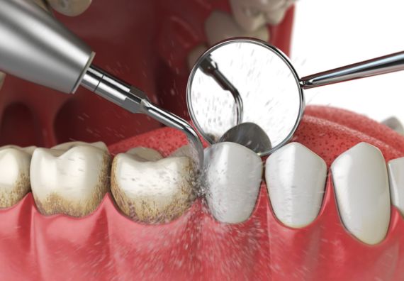 Teeth Cleaning in Goregaon